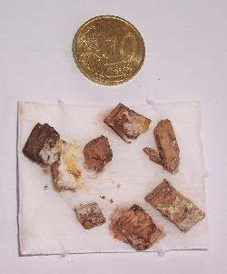 Verstopfung Buchen-Hack